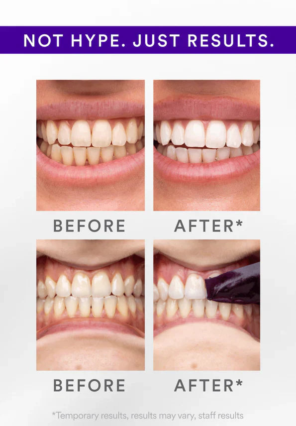 V34 Whitening Strips