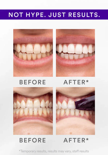V34 Whitening Strips